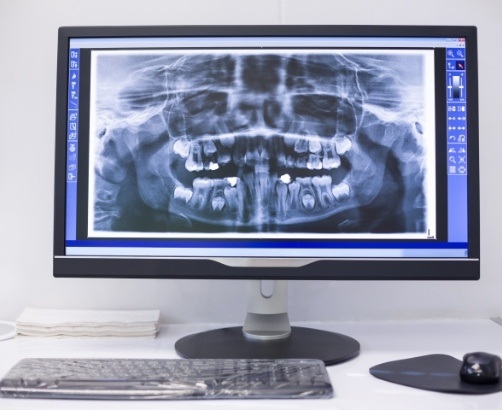 Digital x rays on chairside computer screen