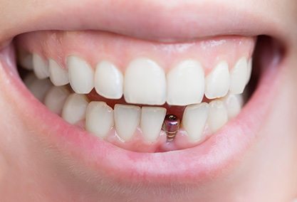 Closeup of a dental implant