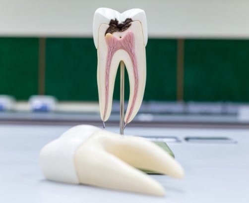 Model tooth with decay in need of root canal treatment