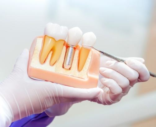 Dentist using smile model to explain the four step dental implant process