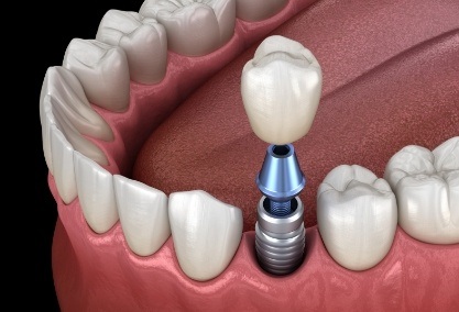 Animated smile during dental implant supported dental crown placement