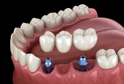 Animated smile during dental implant supported bridge placement