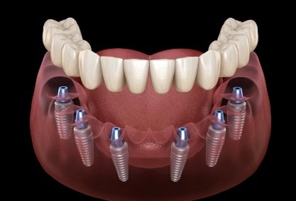 Animated smile during dental implant supported denture placement