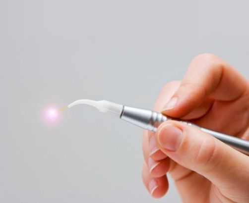 Hand holding a soft tissue laser dentistry hand tool