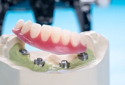 dentures sitting on a plaster mold 