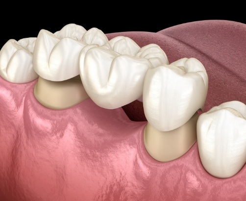 Animated smile during dental bridge placement