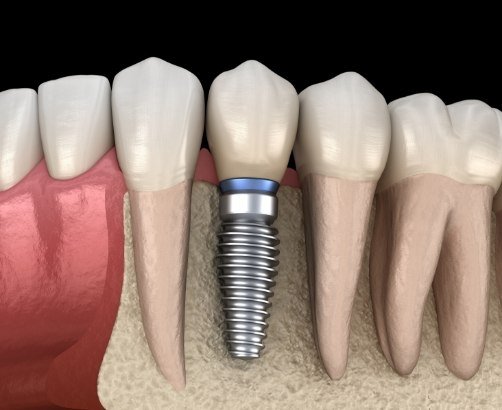 Animated smile with dental implant supported dental crown