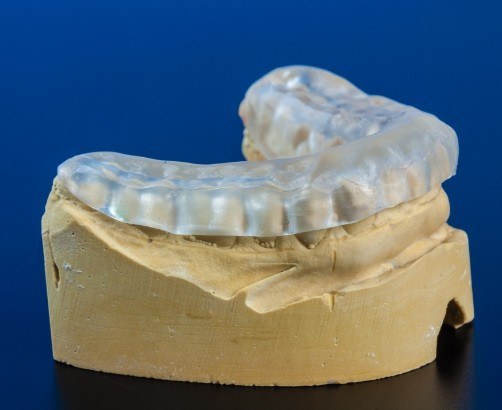 Occlusal splint on smile model