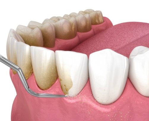 Animated smile during gum disease treatment