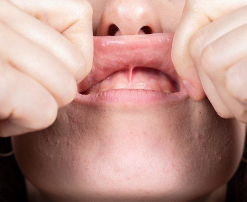 Dentist examining child before performing frenectomy