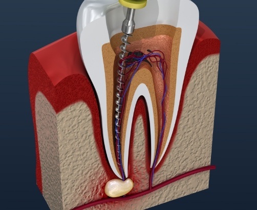 Animated smile during pulp therapy process