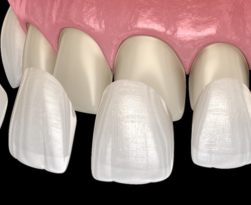 3D render of a set of veneers