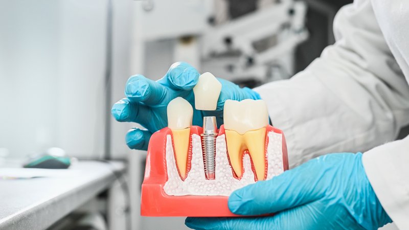 An enlarged model highlighting the various parts of a dental implant